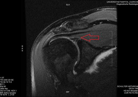 slap labral tear test|mri arthrogram shoulder slap tear.